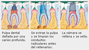 Endodoncia